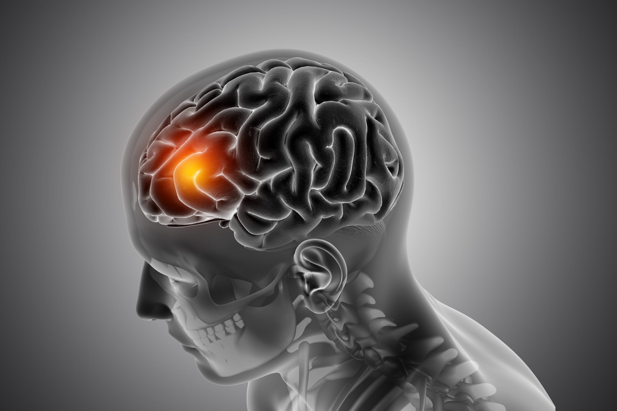 Brain infection symptoms evaluated by Dr. Anadi Mishra, Neurologist in Lucknow