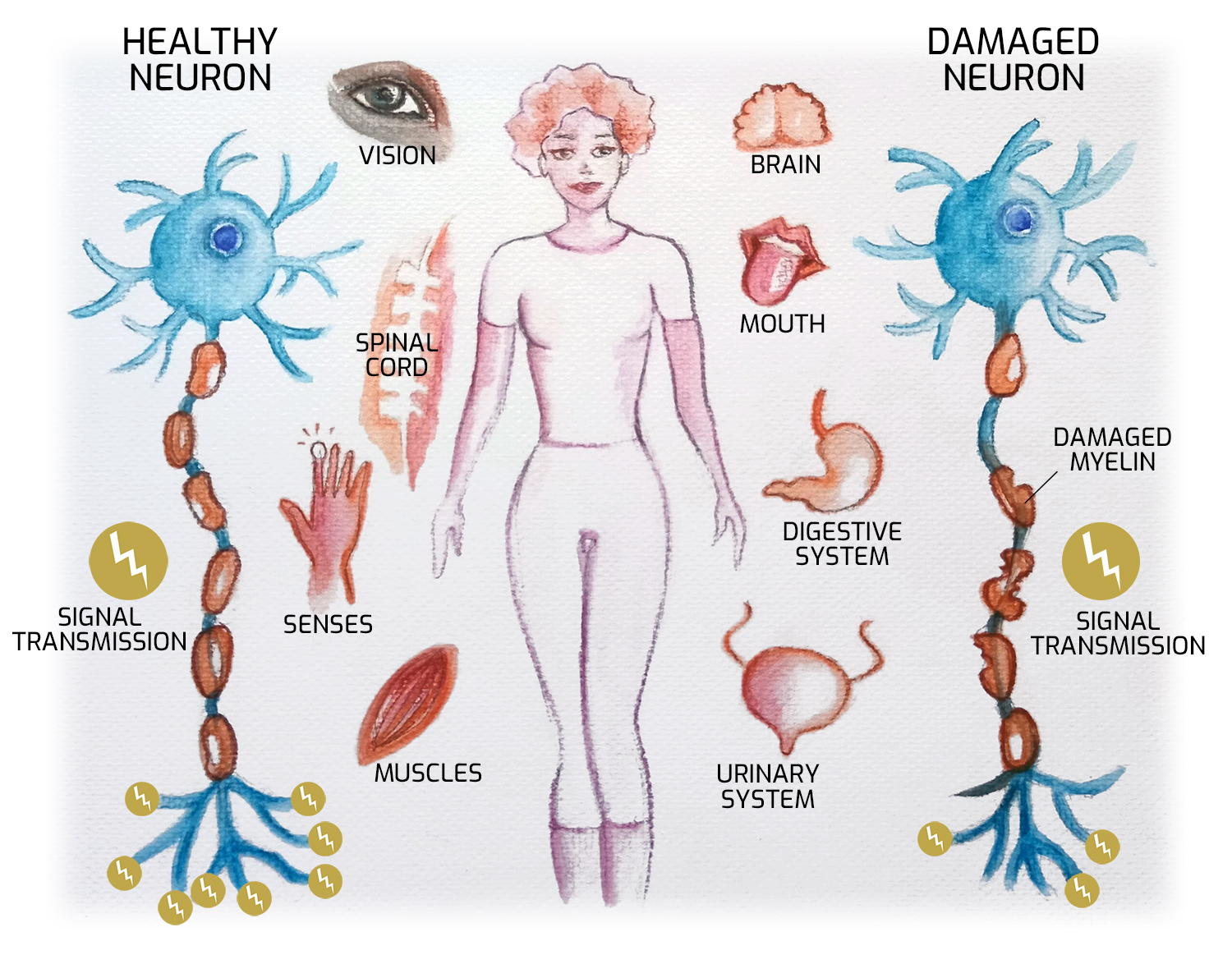 Multiple sclerosis and demyelinating disorder symptoms evaluated by Dr. Anadi Mishra, Neurologist in Lucknow
