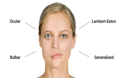 Myasthenia gravis symptoms evaluated by Dr. Anadi Mishra, Neurologist in Lucknow
